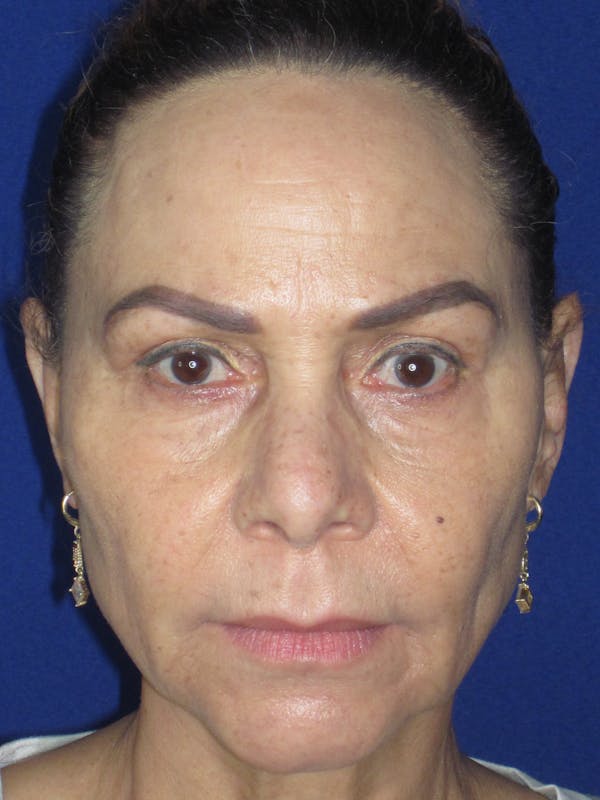 Blepharoplasty Before & After Gallery - Patient 165418111 - Image 4