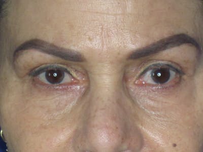 Blepharoplasty Before & After Gallery - Patient 165418111 - Image 2