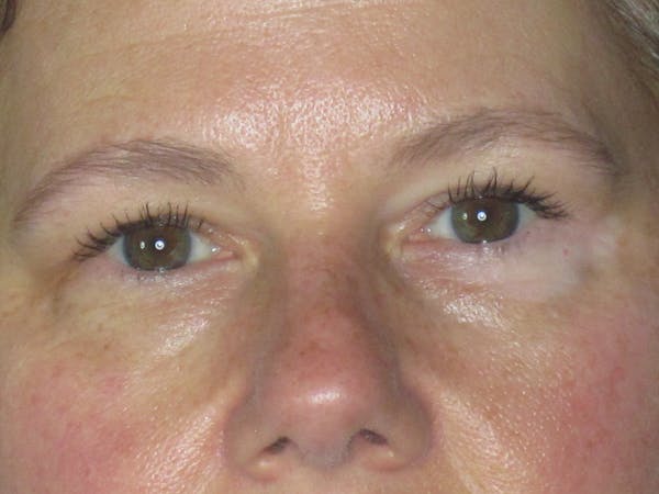 Blepharoplasty Before & After Gallery - Patient 165418287 - Image 2