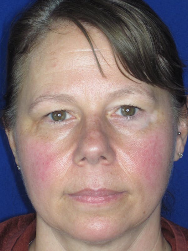 Blepharoplasty Before & After Gallery - Patient 165418287 - Image 3
