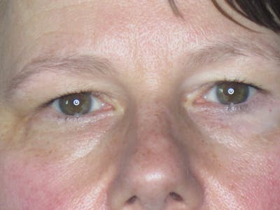 Blepharoplasty Before & After Gallery - Patient 165418287 - Image 1