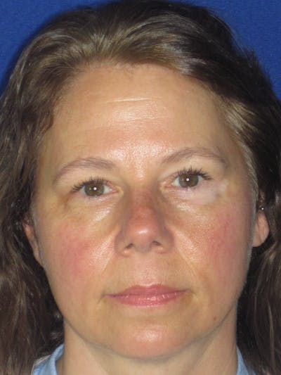 Blepharoplasty Before & After Gallery - Patient 165418287 - Image 4