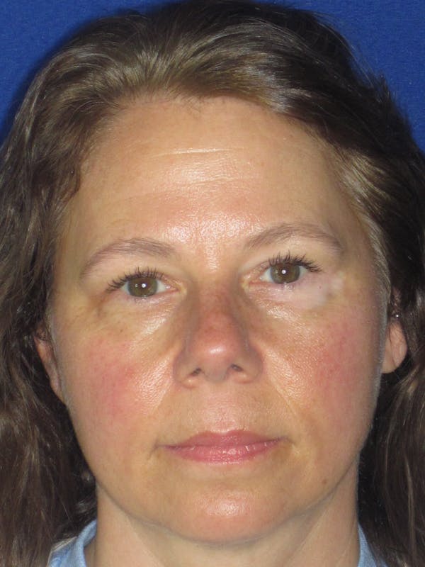 Blepharoplasty Before & After Gallery - Patient 165418287 - Image 4