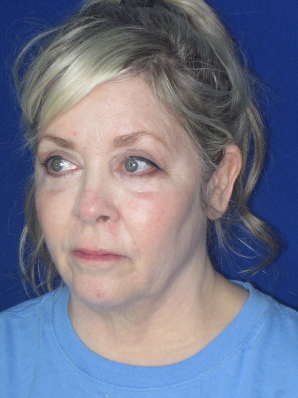 Facelift/Mini-Facelift Before & After Gallery - Patient 172689739 - Image 3