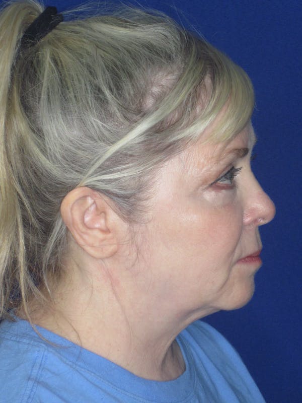 Facelift/Mini-Facelift Before & After Gallery - Patient 172689739 - Image 5