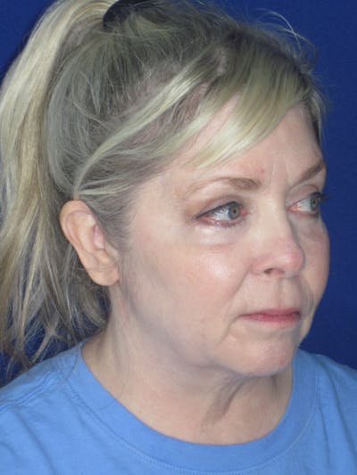 Facelift/Mini-Facelift Before & After Gallery - Patient 172689739 - Image 1