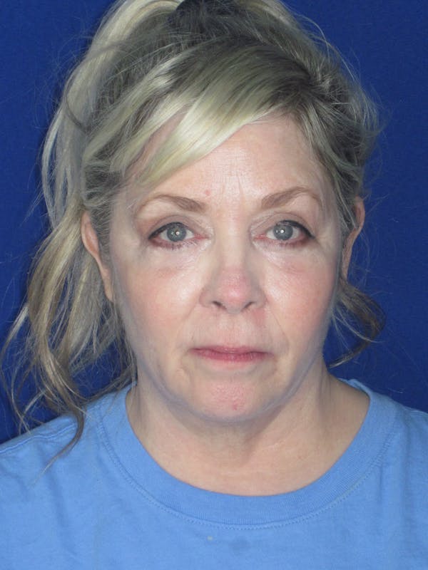 Facelift/Mini-Facelift Before & After Gallery - Patient 172689739 - Image 7