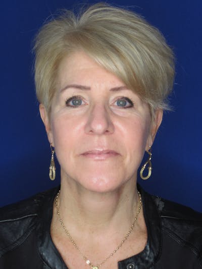 Facelift/Mini-Facelift Before & After Gallery - Patient 396269 - Image 2