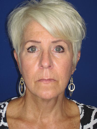 Facelift/Mini-Facelift Before & After Gallery - Patient 396269 - Image 1