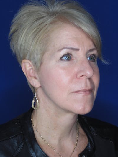 Facelift/Mini-Facelift Before & After Gallery - Patient 396269 - Image 4