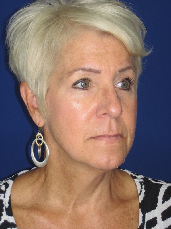 Facelift/Mini-Facelift Before & After Gallery - Patient 396269 - Image 3