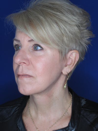 Facelift/Mini-Facelift Before & After Gallery - Patient 396269 - Image 6