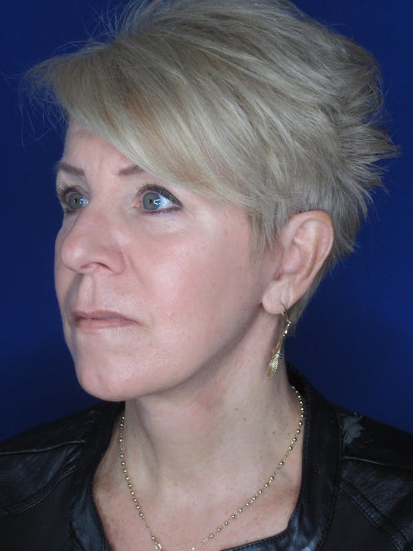 Facelift/Mini-Facelift Before & After Gallery - Patient 396269 - Image 6