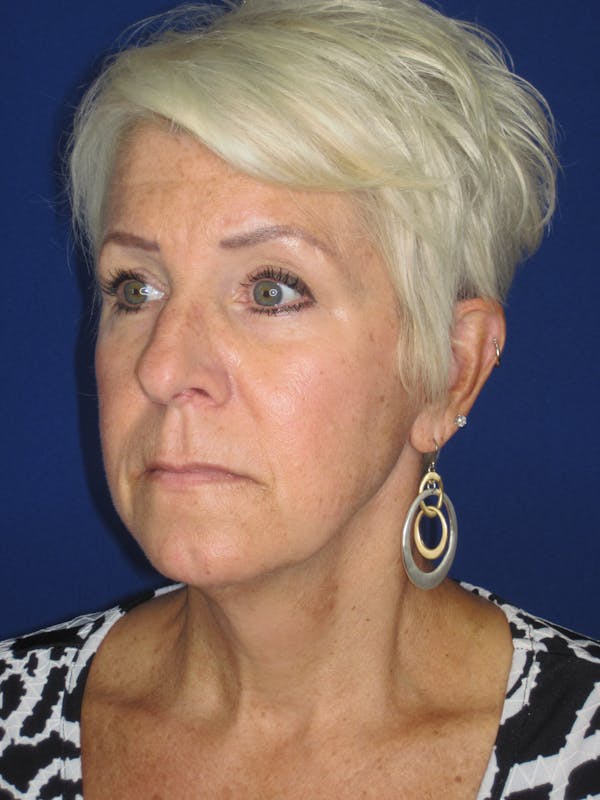 Facelift/Mini-Facelift Before & After Gallery - Patient 396269 - Image 5