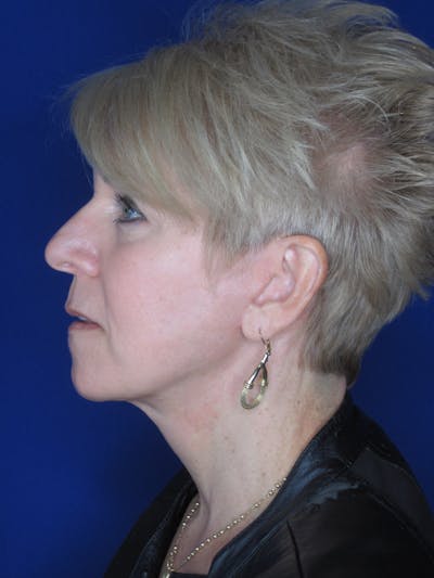 Facelift/Mini-Facelift Before & After Gallery - Patient 396269 - Image 8