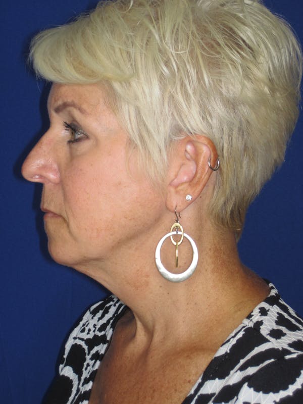 Facelift/Mini-Facelift Before & After Gallery - Patient 396269 - Image 7