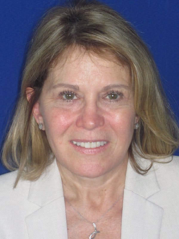 Facelift/Mini-Facelift Before & After Gallery - Patient 184664 - Image 4