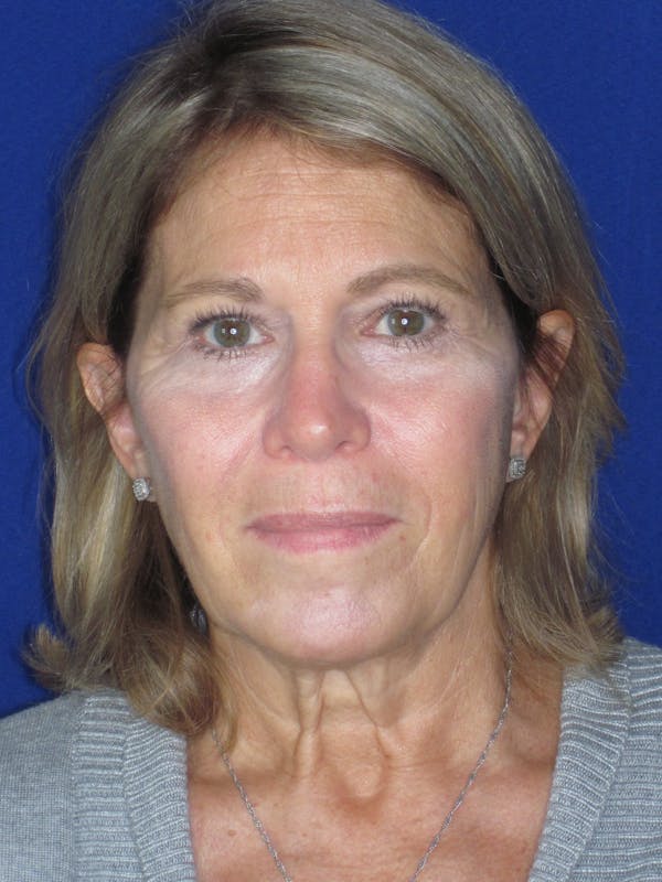 Facelift/Mini-Facelift Before & After Gallery - Patient 184664 - Image 3