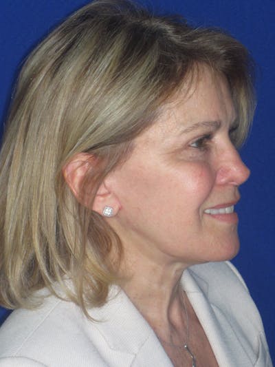 Facelift/Mini-Facelift Before & After Gallery - Patient 184664 - Image 6