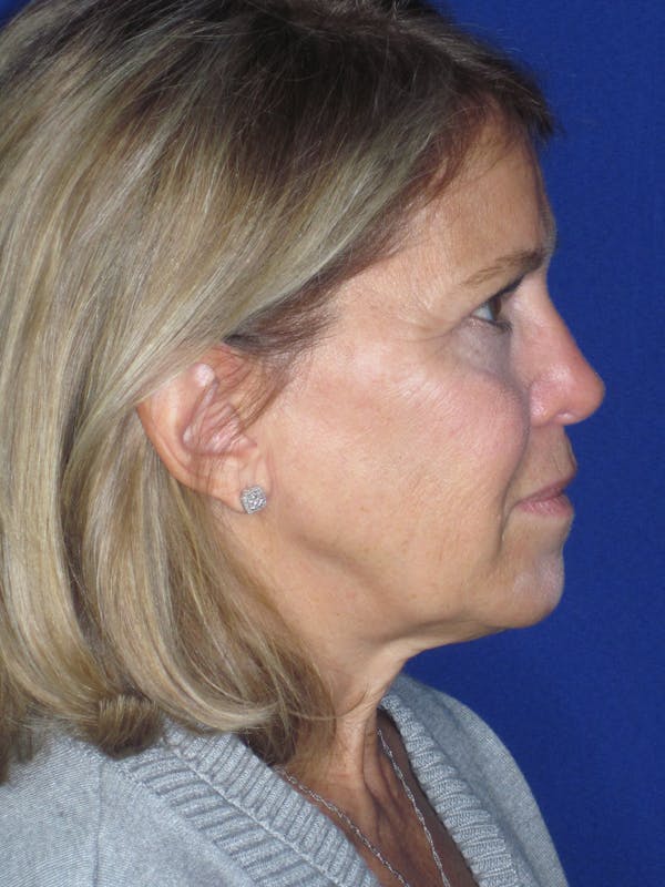 Facelift/Mini-Facelift Before & After Gallery - Patient 184664 - Image 5