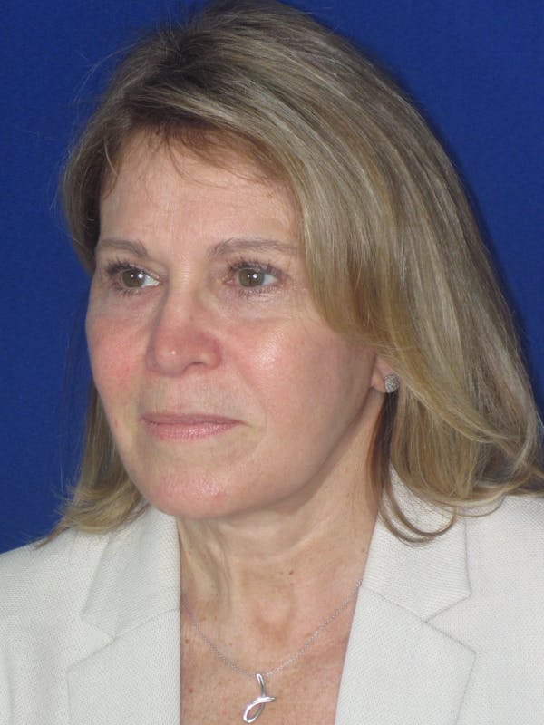 Facelift/Mini-Facelift Before & After Gallery - Patient 184664 - Image 8
