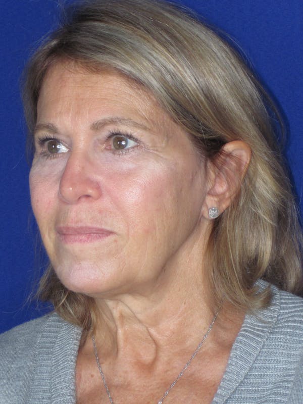 Facelift/Mini-Facelift Before & After Gallery - Patient 184664 - Image 7