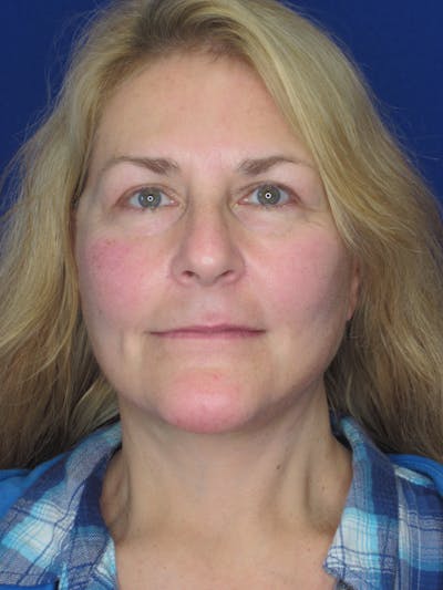 Facelift/Mini-Facelift Before & After Gallery - Patient 171330 - Image 2