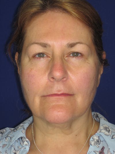 Facelift/Mini-Facelift Before & After Gallery - Patient 171330 - Image 1