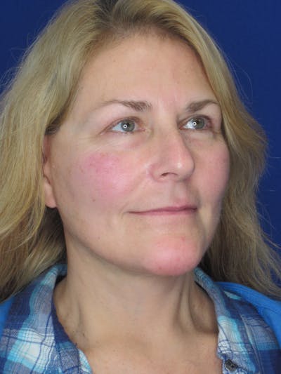 Facelift/Mini-Facelift Before & After Gallery - Patient 171330 - Image 4