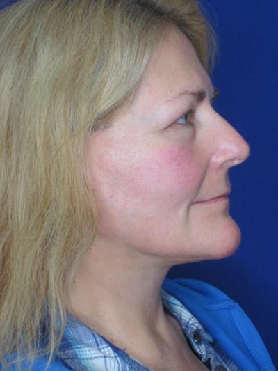 Facelift/Mini-Facelift Before & After Gallery - Patient 171330 - Image 6