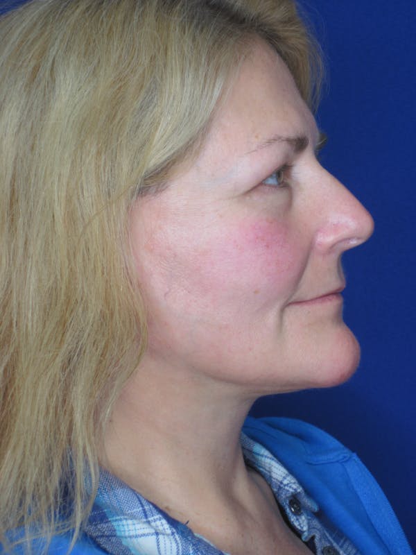 Facelift/Mini-Facelift Before & After Gallery - Patient 171330 - Image 6