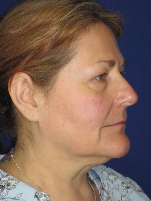 Facelift/Mini-Facelift Before & After Gallery - Patient 171330 - Image 5