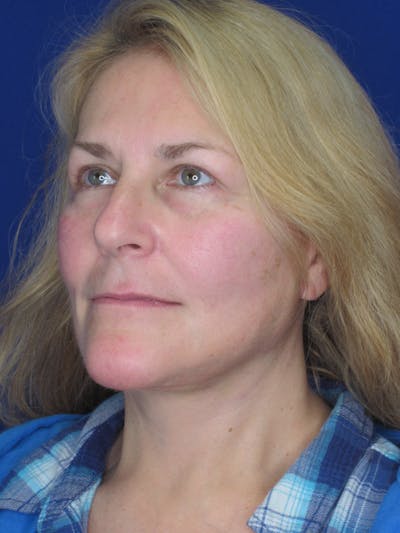 Facelift/Mini-Facelift Before & After Gallery - Patient 171330 - Image 8