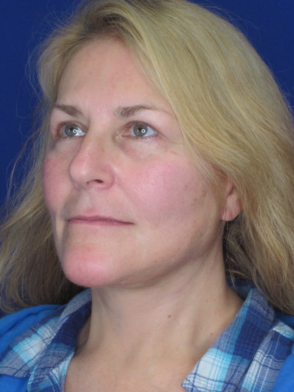 Facelift/Mini-Facelift Before & After Gallery - Patient 171330 - Image 8