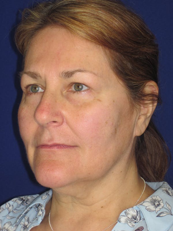 Facelift/Mini-Facelift Before & After Gallery - Patient 171330 - Image 7