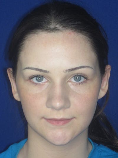 Otoplasty 