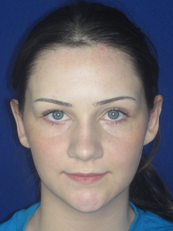Otoplasty 