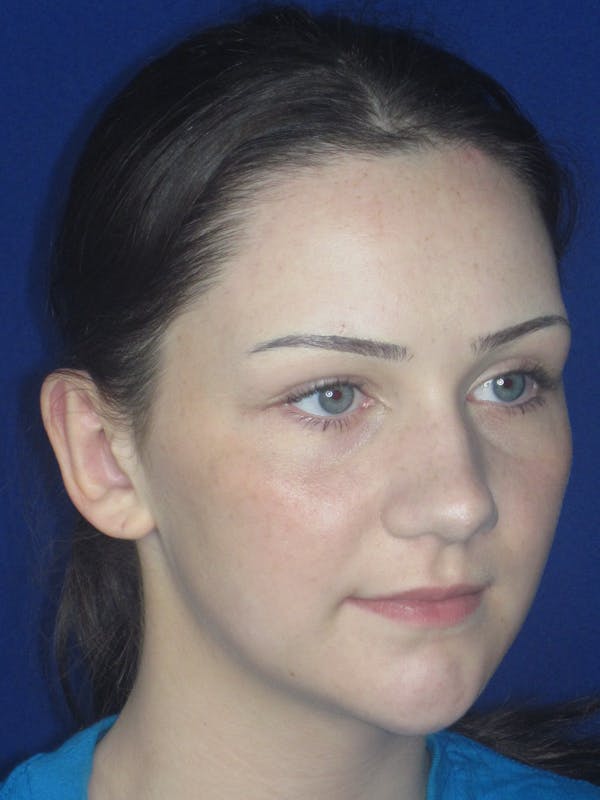 Otoplasty 