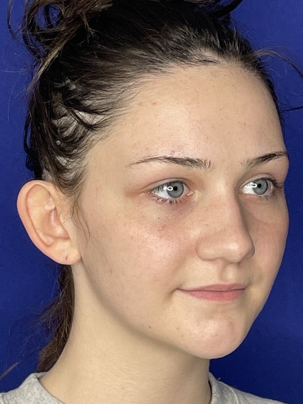 Otoplasty 