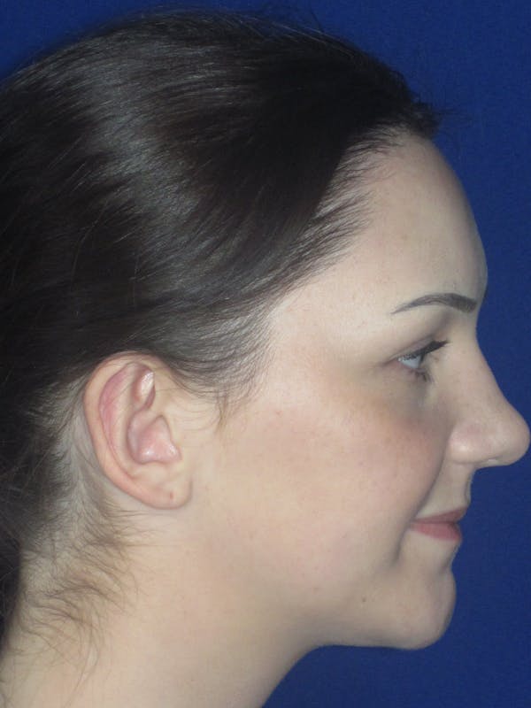 Otoplasty 
