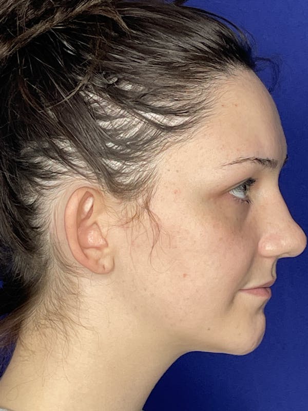 Otoplasty 
