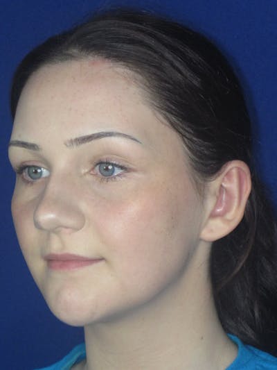 Otoplasty 