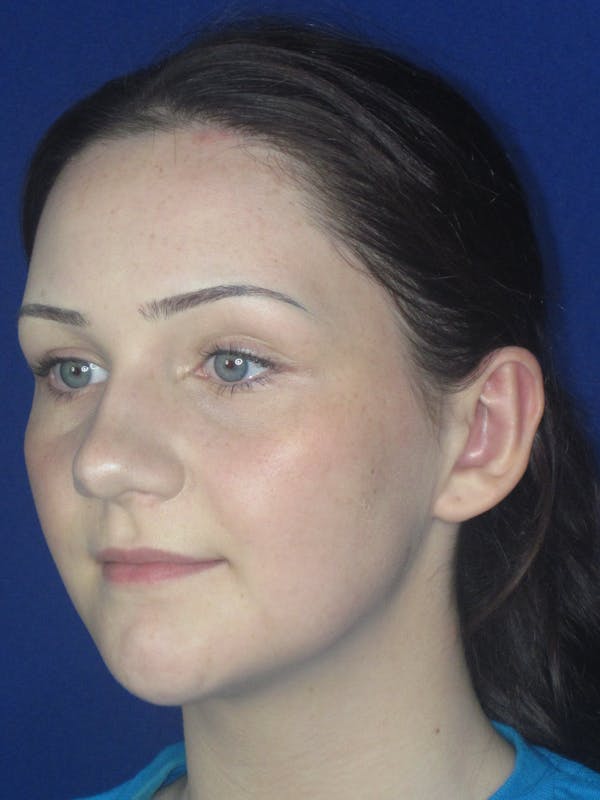 Otoplasty 