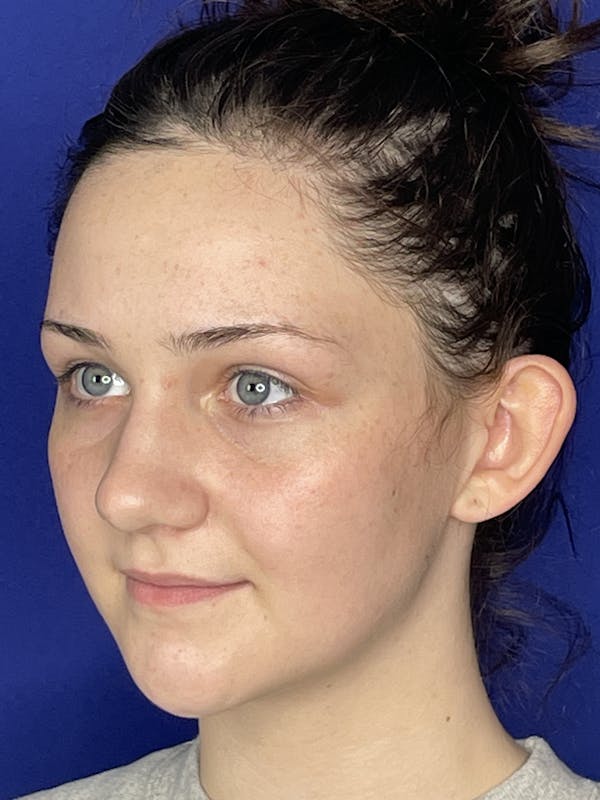 Otoplasty 