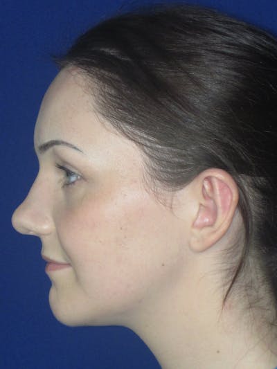 Otoplasty 