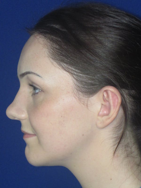 Otoplasty 