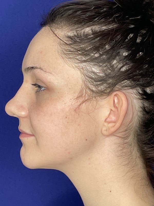 Otoplasty 