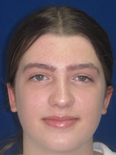 Otoplasty 