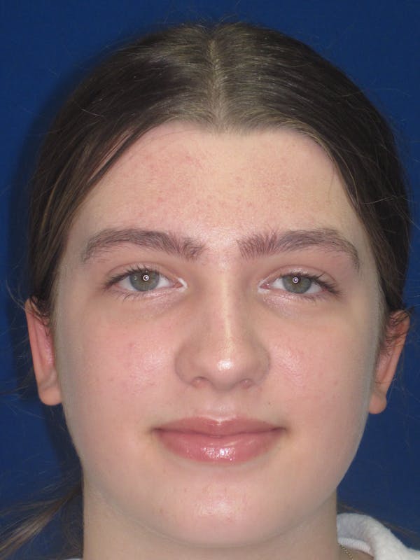 Otoplasty 