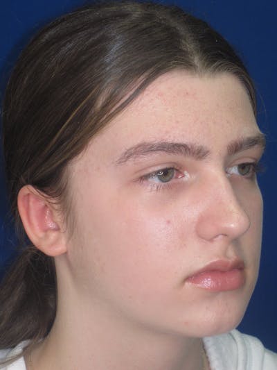 Otoplasty 